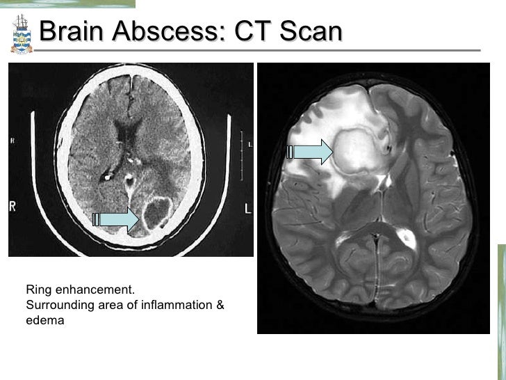 ct scan report sle brain ct scan report sle 28 images cessation of ct scan report sle brain ct scan report sle 28 images cessation of