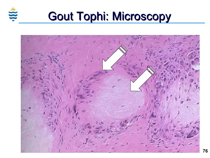 Gouty tophi | Primary Care Dermatology Society | UK