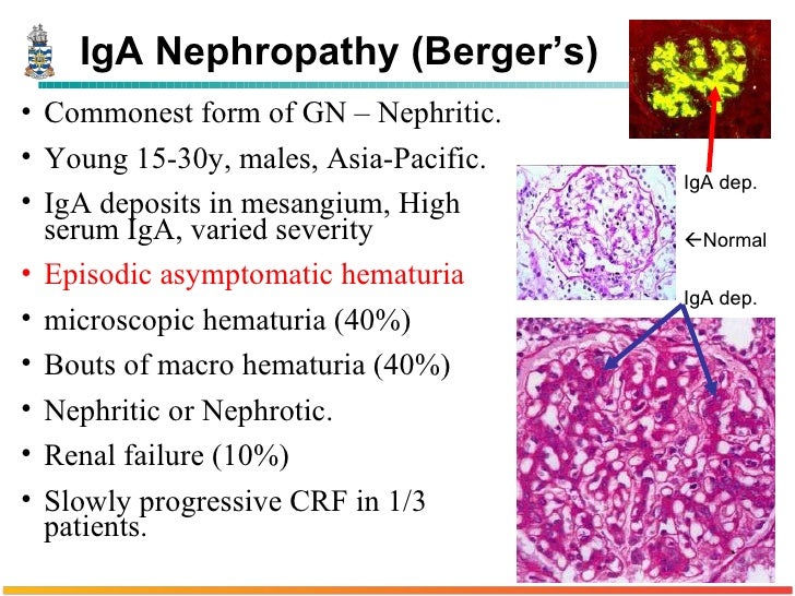 Pathology of Glomerulonephritis