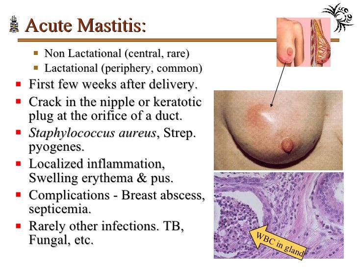 Mastitis February 2016