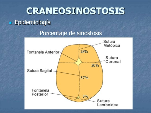 Craneosinostosis Craneosinostosis