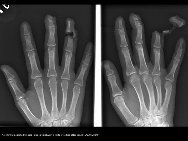 jammed finger xray jammed finger xray