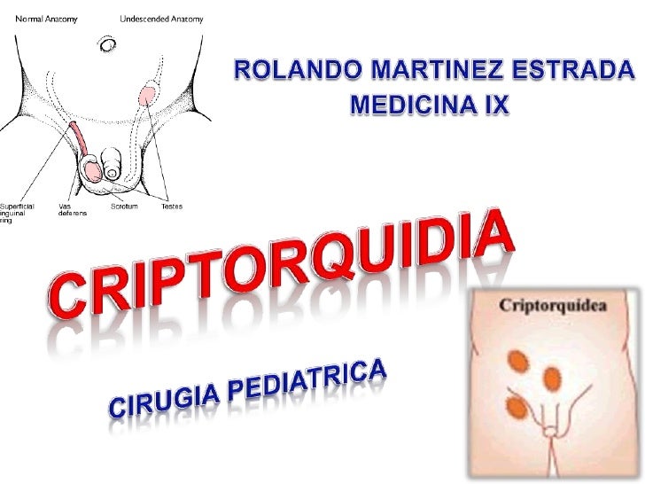 Criptorquidia
