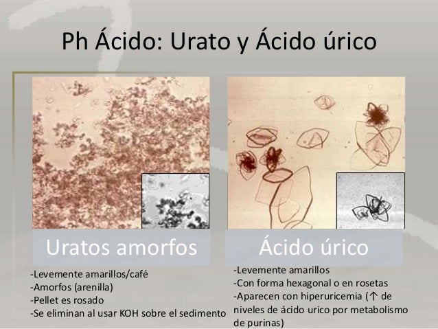 Exame de urina uratos amorfos