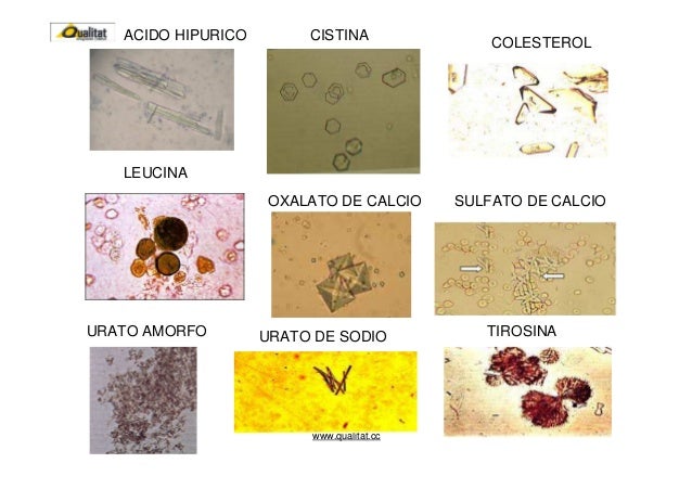 Cristales calculos orina