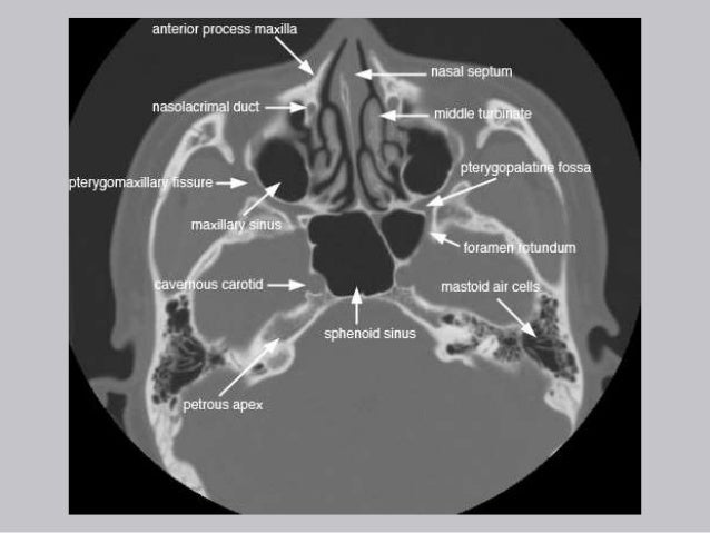 Cross Sectional Anatomy of Paranasal sinus