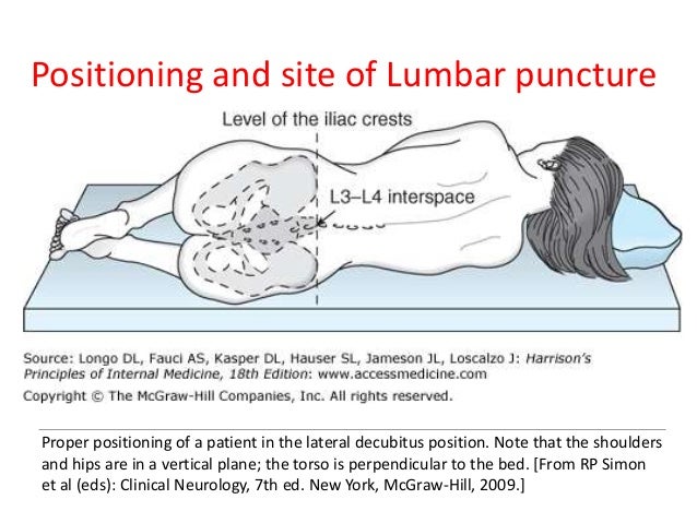 nerve pain after lumbar puncture nerve pain after lumbar puncture