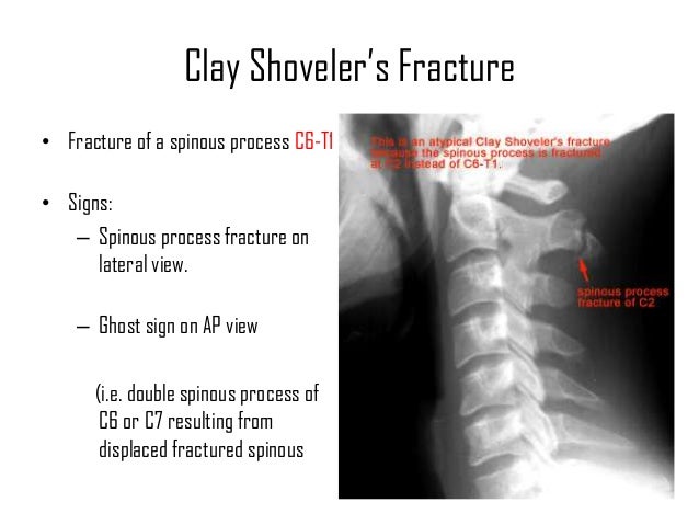 Cervical Fractures and Cervical spine injuries - Dr.KK