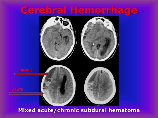 dating subdural hemorrhage dating subdural hemorrhage