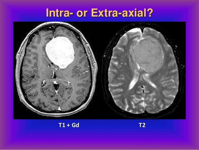 ct scan vs mri
