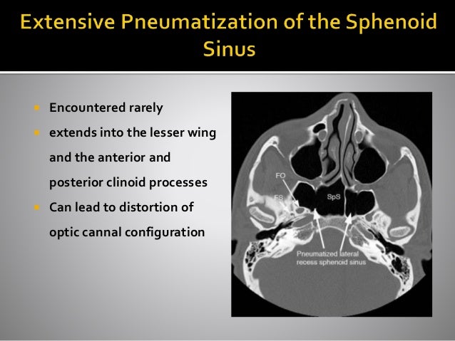 remedy for sinus blockage chronic maxillary sinusitis of dental foundation