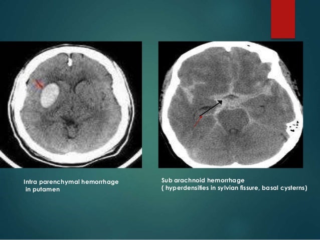 mini stroke mri pics