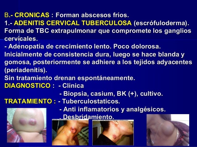 Ha tirado el cuello duele la garganta
