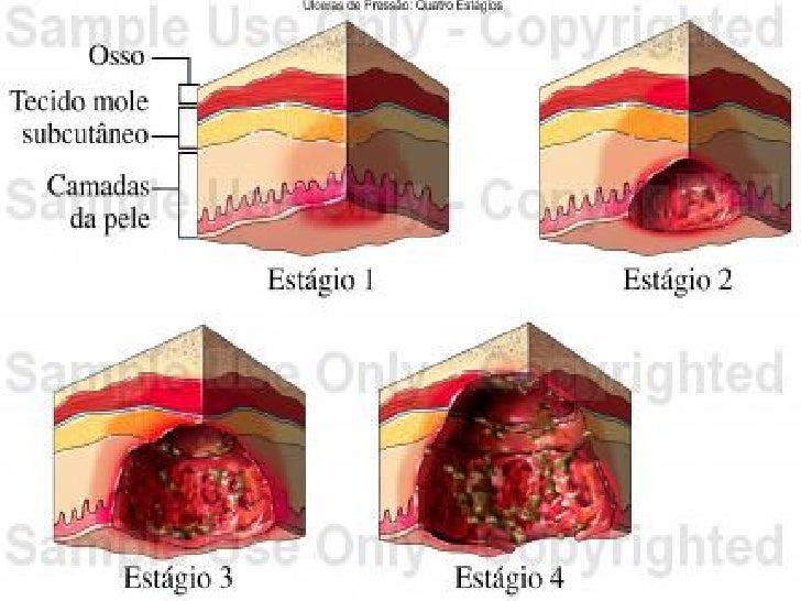Cuidados com feridas