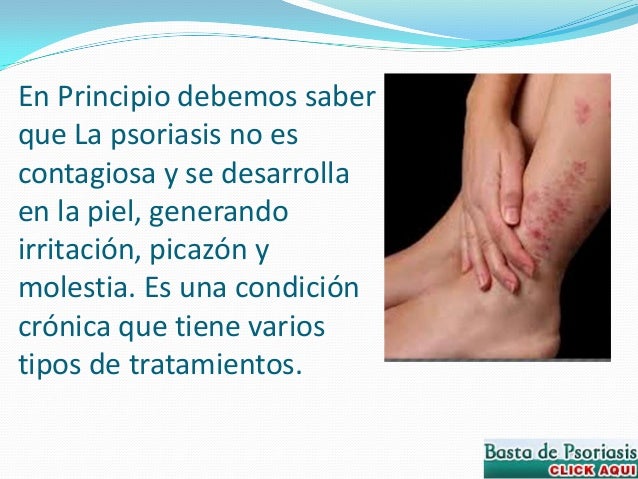 El ungüento de la eccema en las manos del ungüento