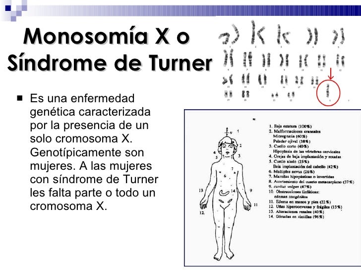 El Sindrome De Down Es Una Monosomia Y