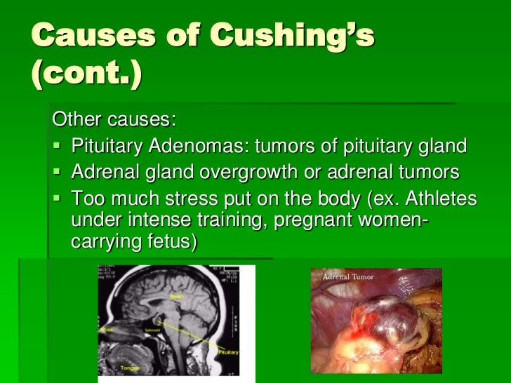 when to put a with cushing s disease cushing s when to put a with cushing s disease cushing s