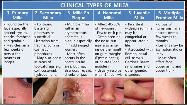Milia in Adults: Condition, Treatments, and Pictures ...