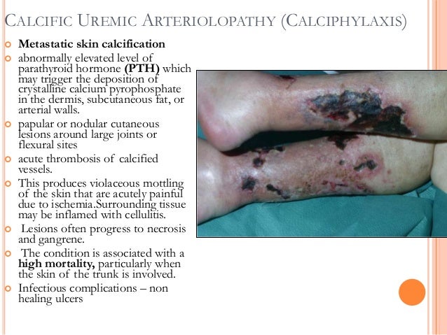 Kidney Dialysis Homeopathy