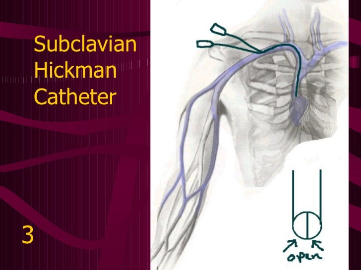 Central Venous Access Devices Made Incredibly Easy!