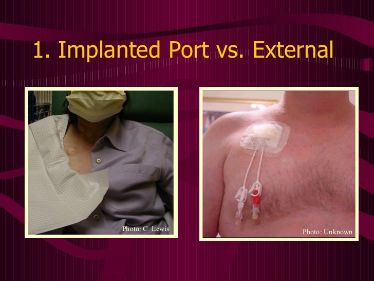 Central Venous Access Devices Made Incredibly Easy!