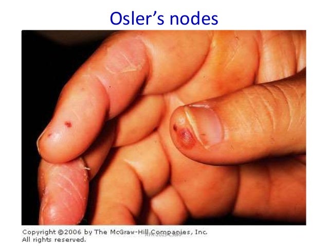 Osler Nodes vs. Janeway Lesions | USMLEMD
