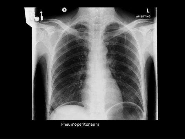 Mesothelioma Pleural Density