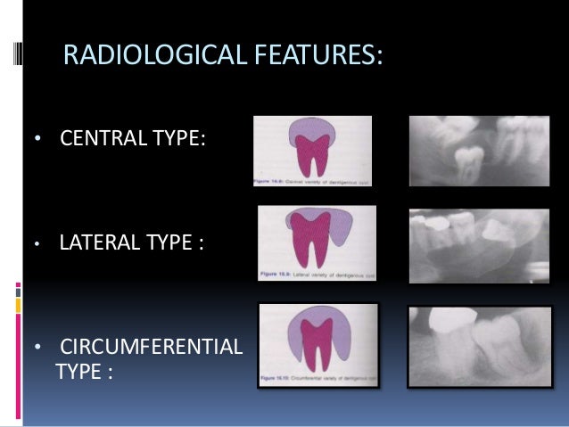 dental cyst
