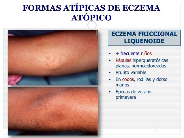 Donde descansar en el mar con la psoriasis