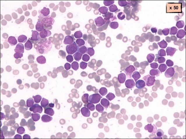 Most cancers killing weight loss plan immunotherapie united states of america