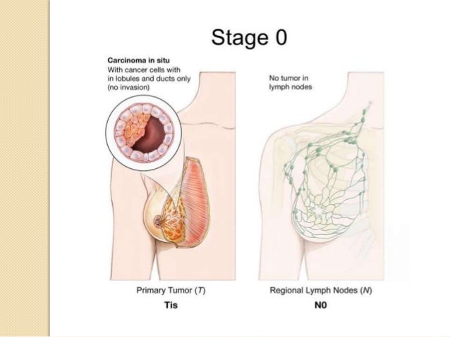 Agree Dcis and breast cancer consider Dcis and breast cancer