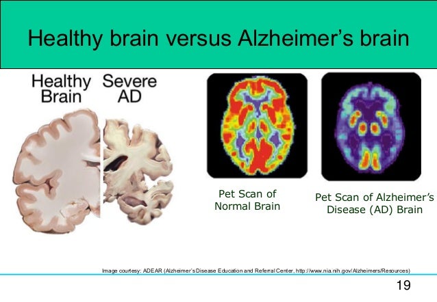 ct scan vs mri