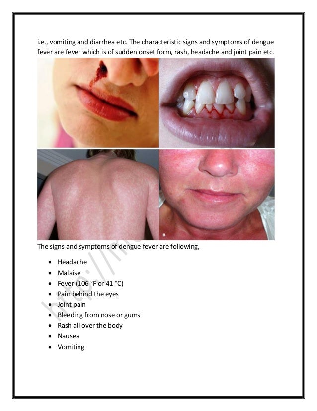 signs of fever dengue fever surgicomed signs of fever dengue fever surgicomed