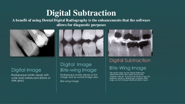 What is digital subtraction radiography image