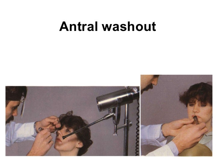 viagra clogged sinuses