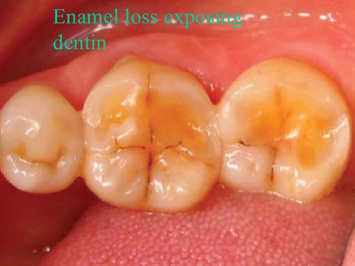 Dentin hypersensitivity final