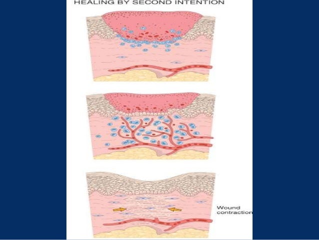 bone fracture healing extraction socket healing healing of nervous ...