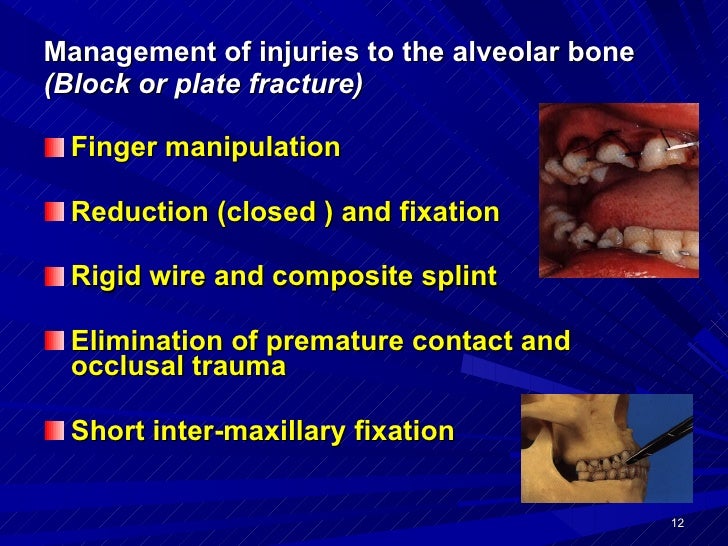 Dento Alveolar Fractures