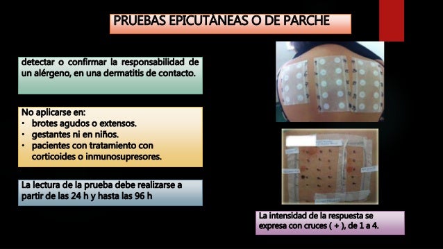 Como distinguir la psoriasis