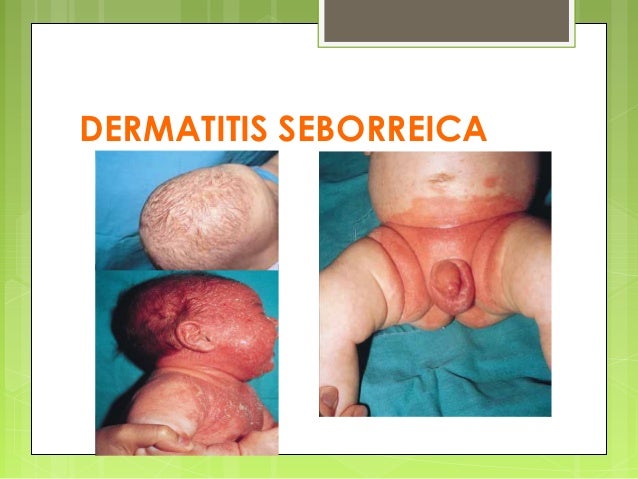 La psoriasis de las uñas los primeros indicios