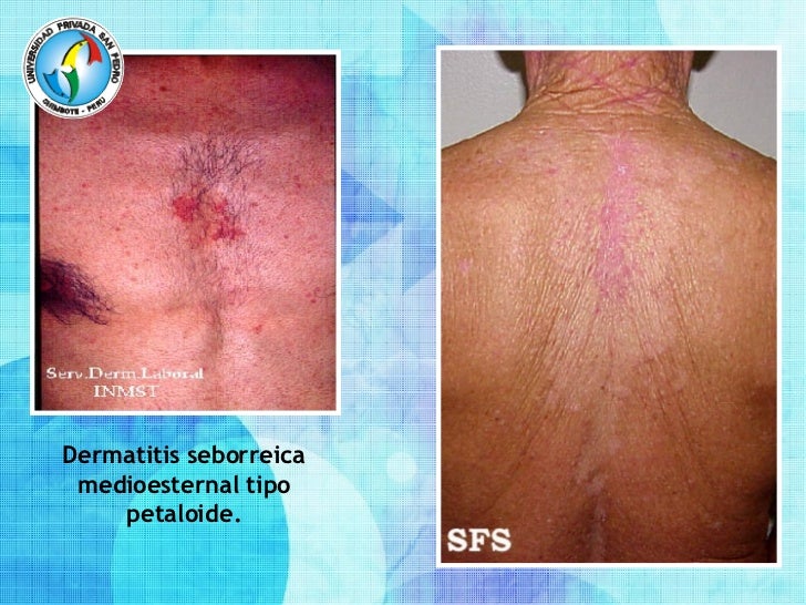Las máscaras para el crecimiento de los cabello de la mostaza y el kéfir