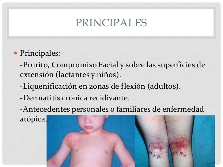 El tratamiento de la psoriasis por buteyko