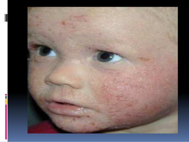 La psoriasis a la diabetes de la foto