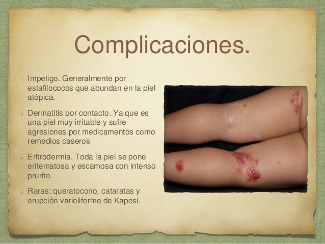 La psoriasis los métodos del tratamiento