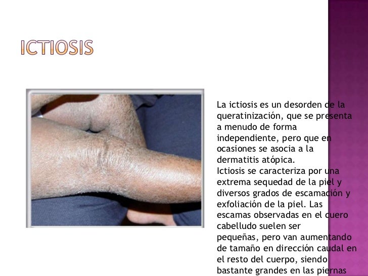 El tratamiento por el alquitrán a la psoriasis