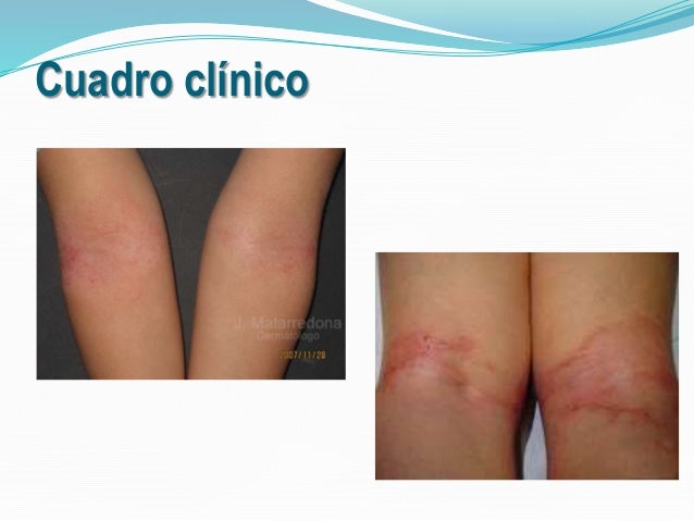 Hofitol de atopicheskogo de la dermatitis