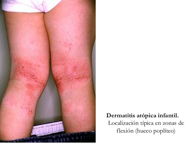 Pahovyy la psoriasis a las mujeres de la foto el tratamiento
