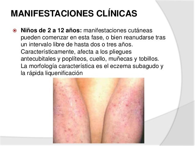 De la psoriasis skin kap las revocaciones