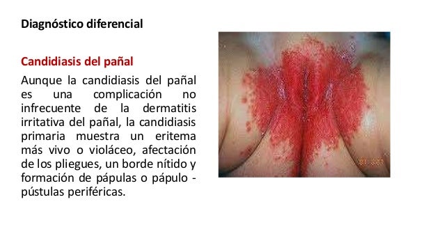 La sauna infrarroja a la psoriasis las revocaciones
