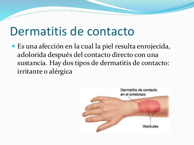El tratamiento de la psoriasis sofora